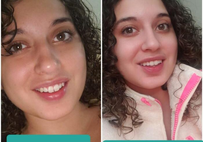 Smile direct club dental retainers nda customer refunds