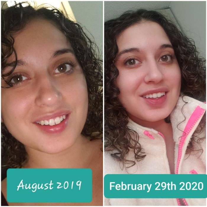 Smile direct club dental retainers nda customer refunds